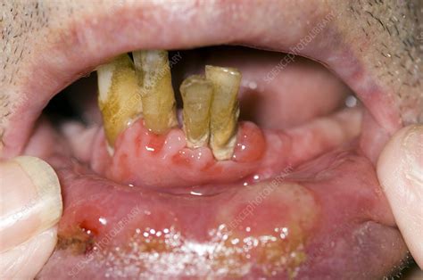 Mouth Ulcers From Myelodysplasia Stock Image M2100379 Science