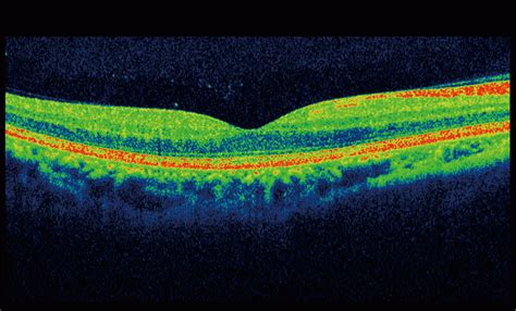 Optical Coherence Tomography Internetgerty