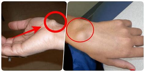 Is A Bump On Your Wrist A Cause For Concern See What To Do
