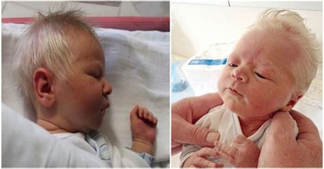 Baby Born With Silver Hair Due To Rare Condition That