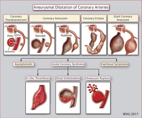 Management Of Coronary Artery Aneurysms Jacc Cardiovascular