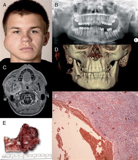 Extensive Aneurysmal Bone Cyst Of The Mandible Journal Of