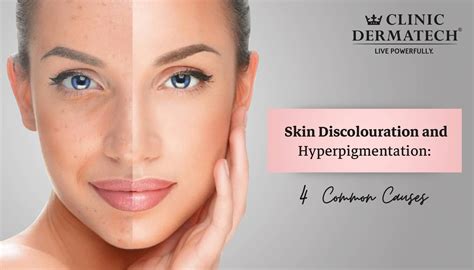 Skin Discolouration And Hyperpigmentation 4 Common Causes Clinic