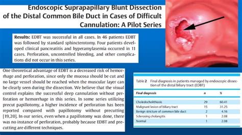 Precut Ercp Fistulotomy Papillotomy Transpancreatic Sphincterotomy