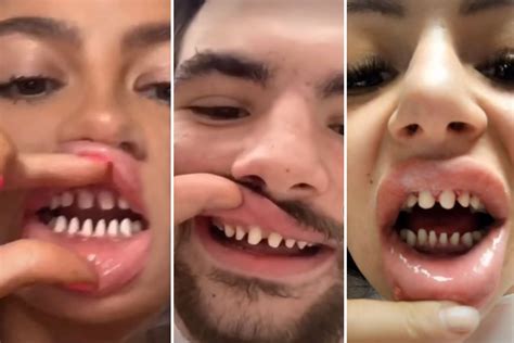 Trend Of Shaving Teeth Down To Pegs To Get ‘perfect Smile With Veneers