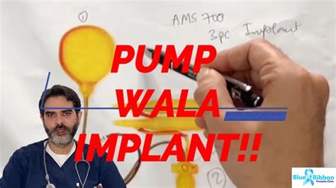 Ams Lgx Pc Inflatable Penile Prosthesis Pump Aur Button Wala Implant YouTube