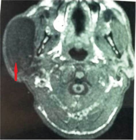 Intraparotid Ductal Ectasia Rare Cause Of Parotid Swelling Bmj Case