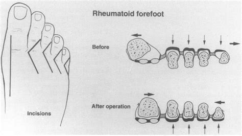 A Incisions For Forefoot Reconstruction B Diagrammatic