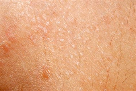 Texture De Peau Allergique Dermatite éruption Cutanée — Photographie
