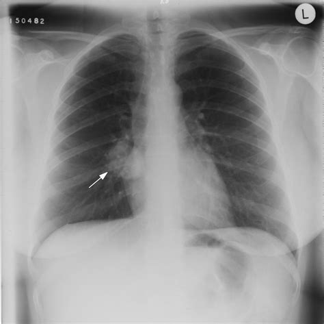 Solid Pulmonary Nodules