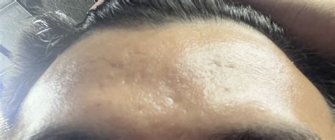 Temple And Forehead Scarring What Scars Are These And What Treatment