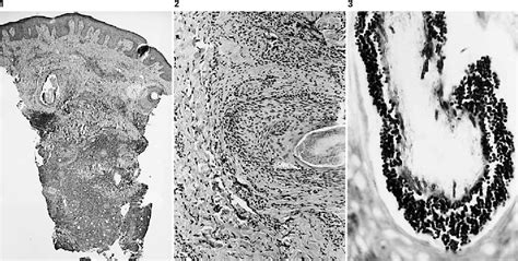 Figure 1 From Trichophytic Granuloma Of The Vulva Semantic Scholar