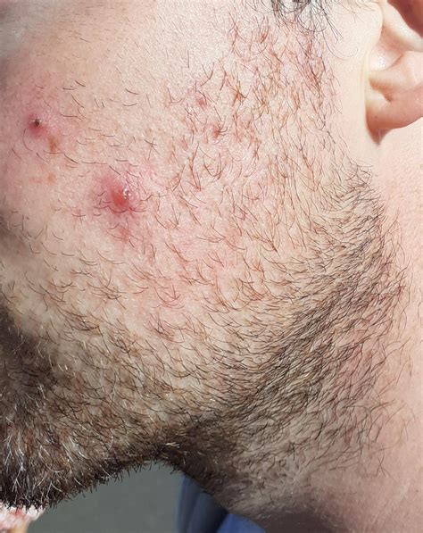 I Constantly Have Large Boilsspots Like This On My Cheeks At Least 1