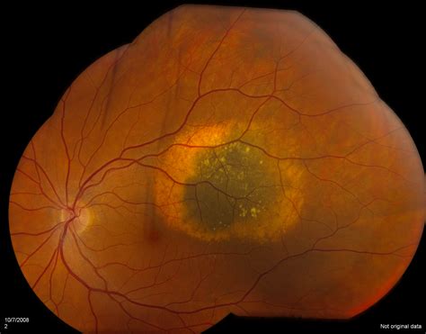 Choroidal Nevus Benign Retina Growth Retina Specialist Orange County