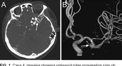 Intraoperative Premature Rupture Of Middle Cerebral Artery Aneurysms