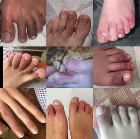 If Your Toes Are Swollen Purple And Painful To The Touch You May Have