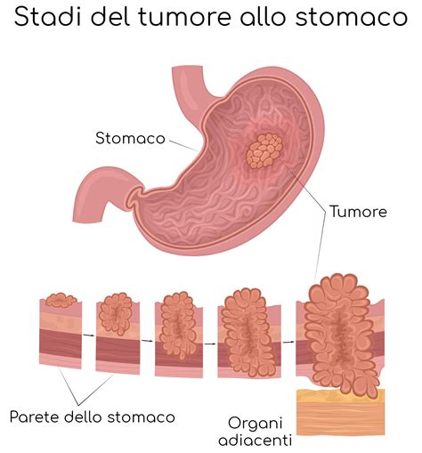 Tumore Allo Stomaco Sintomi Sopravvivenza Diagnosi Valori Normali