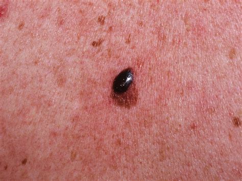 Skin Cancer Types Symptoms Melanoma And Treatment