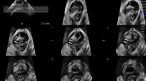 Urogynecology And Pelvic Floor Ultrasound