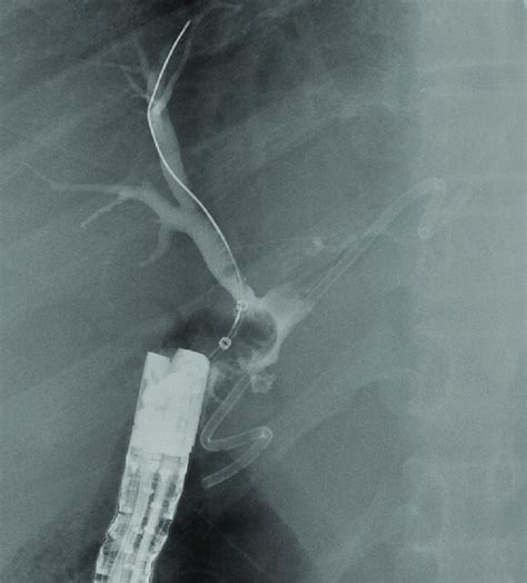Fluoroscopic Image Cholangiogram Showing Successful Download