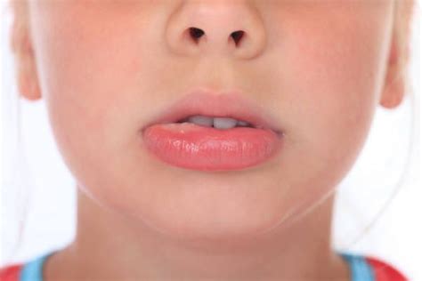In order to moisturize the lips and lower the swelling, you should apply petroleum jelly on regular using lip balm can be considered as a tremendous natural home remedy for swollen lip. How to Get Rid Of a Mucous Cyst or Mococele? (Mucous Cyst ...