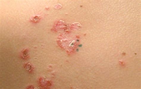 Indian Fire Rash Pictures Treatment Symptoms Causes