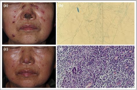 Image Gallery Facial Sporotrichosis Xiang 2018 British Journal