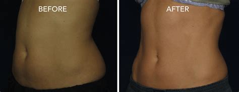 Coolsculpting Beforeafter Photos Dermmedica