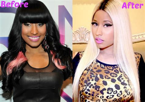 Nicki Minaj Plastic Surgery Before After Photos Celebrities Plastic