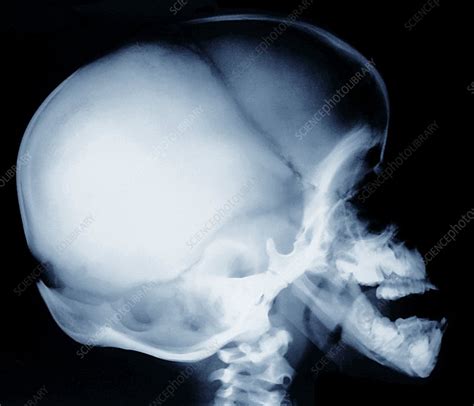 Bone Growth Disorder Of Skull X Ray Stock Image C0095371