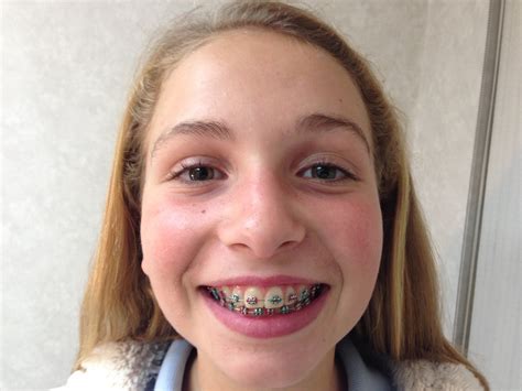 Orthodontist In Forest Hills Bronx And Rockville Centre Ny Braces And Invisalign Halberstadt