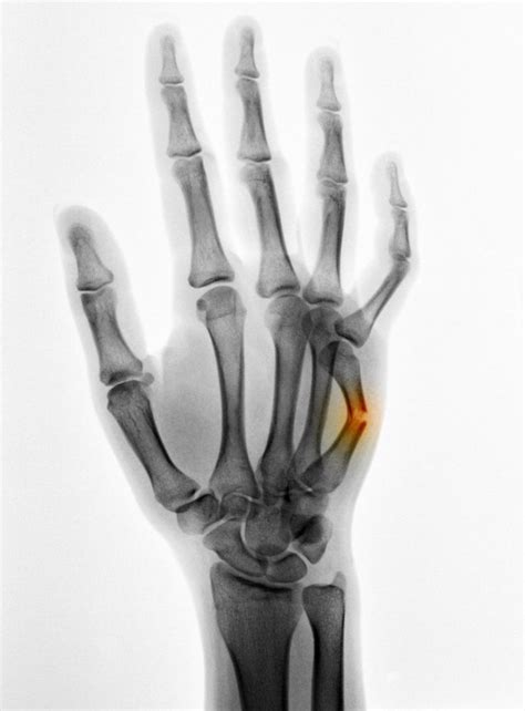 What You Need To Know About Metacarpal Fracture Hand Fracture Hand