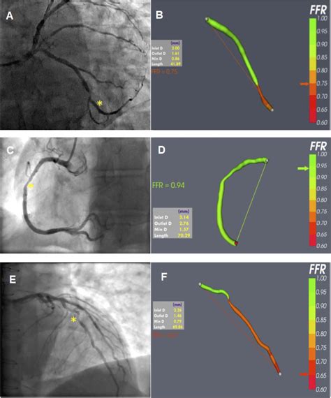 The New Role Of Diagnostic Angiography In Coronary Physiological