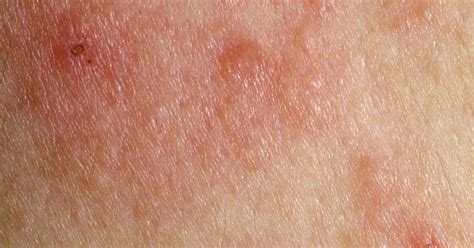 Skin Rashes And Cancer