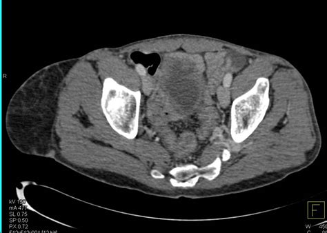 Liposarcoma Right Buttocks Musculoskeletal Case Studies Ctisus Ct
