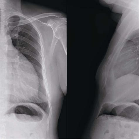 Chest Radiograph Chest Radiograph Of This Patient Showing Cardiac