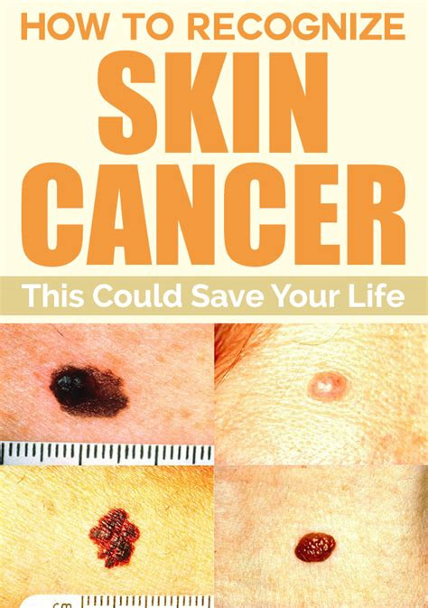 How To Recognize Skin Cancer This Could Save Your Life Herbs Health