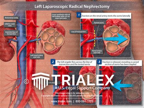 Left Laparoscopic Radical Nephrectomy Trialexhibits Inc