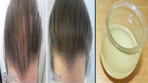 How To Treat Baldness Or Regrow Hair On Bald Spot Home Remedy Youtube