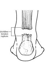 Posted on april 3, 2019april 3, 2019. Achilles Tendon Rupture - Foot Health Facts