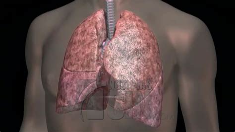 Al evaluar la fibrosis pulmonar el primer objetivo debe ir dirigido a clasificar la enfermedad. ¿Qué es la fibrosis pulmonar y cuáles son sus principales síntomas? - YouTube