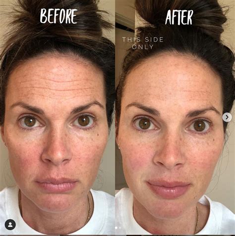 Botox For Bags Under Eyes