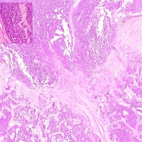 Pathology Of An Eye With Enucleated Retinoblastoma Showing Optic Nerve