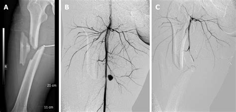 Missed Diagnosis Of Femoral Deep Artery Rupture After Femoral Shaft