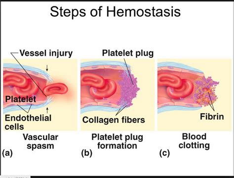 Blood may flow out of the body, as external bleeding, or it may flow into. Hemostasis has three major steps: Vasoconstriction (vascular spasm) Formation of platelet plug ...