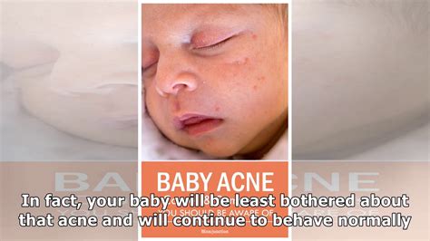 Baby Acne What Causes Them And How You Can Prevent Youtube