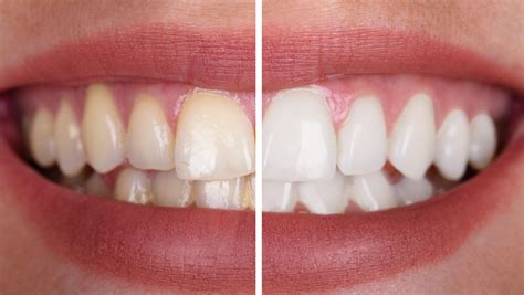 Deep Teeth Cleaning Before And After Dental Health Society