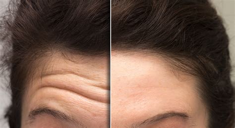 Botox Aftercare Renew Medical Aesthetics Cheshire Clinic