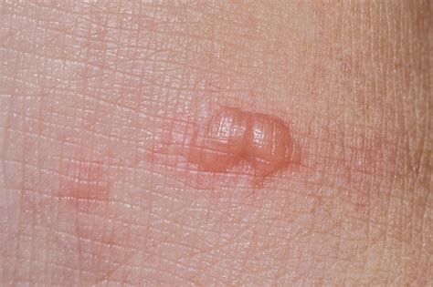 Closeup Of Skin With Blistersburn Wound Skin Stock Photo Download
