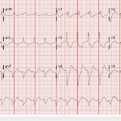 Electrocardiogram Ecg Showing Supraventricular Tachycardia With